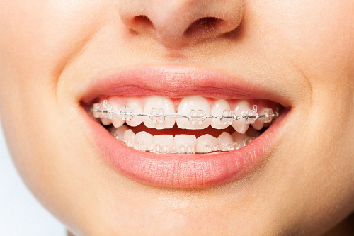 在深圳矫正牙齿有年龄限制吗