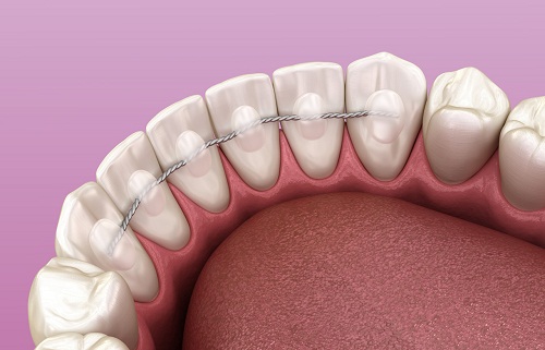深圳爱康健口腔牙齿矫正的过程要多久?一般要花多少钱