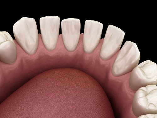 请问爱康健口腔牙齿间有缝隙有哪些修复方式
