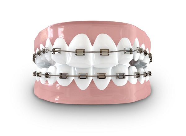 地包天怎麽區分輕度和重度?深圳矯齒箍牙價錢幾多?