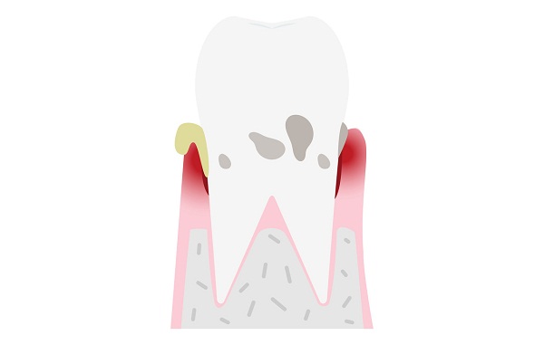 牙槽骨吸收不可逆?问爱康健齿科如何控制牙槽骨吸收?