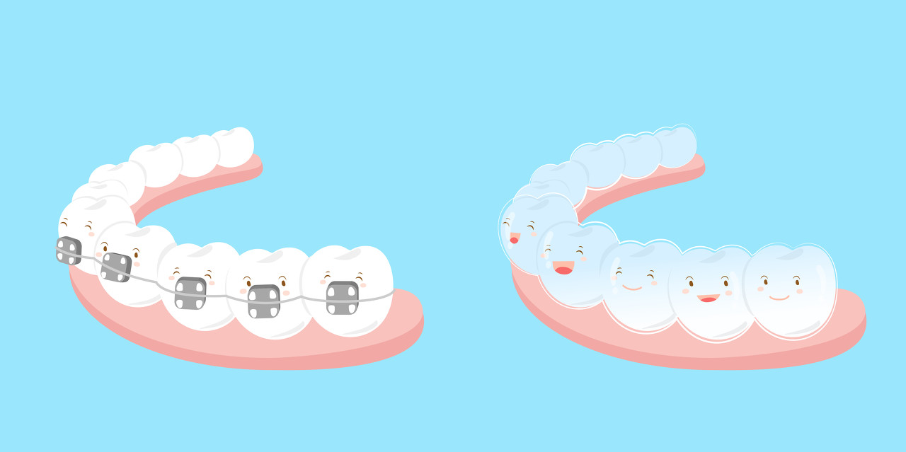 牙齿矫正一般是拔哪些牙？牙齿矫正深圳哪家医院好？