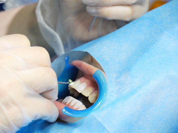 洗牙能讓牙齒變白嗎