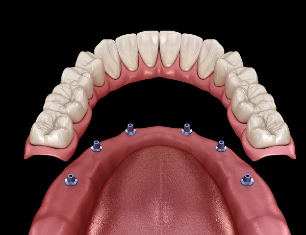 深圳半口種植牙多少錢