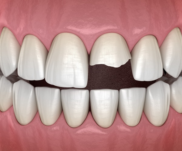 門牙崩掉了怎麼辦