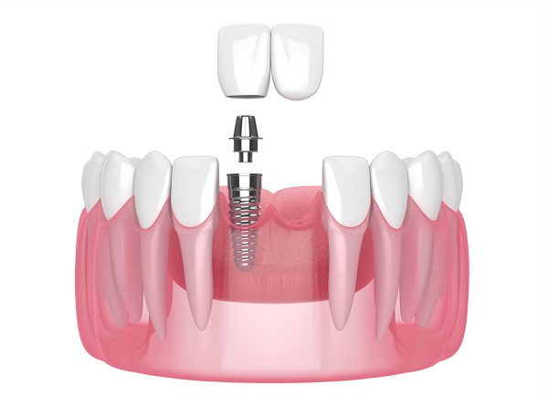 深圳種植牙幾多錢一隻