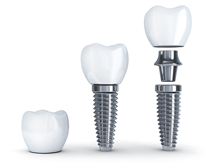 種植牙是材料重要還是醫生技術重要