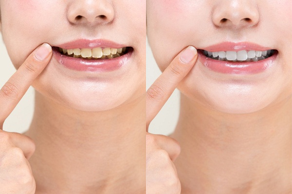 深圳牙齒美白多少錢