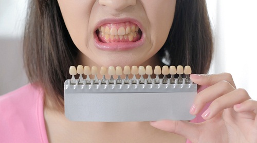 深圳瓷貼面收費