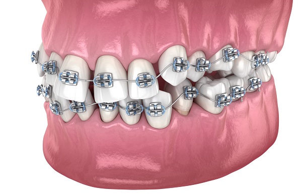 深覆合有必要矯正嗎