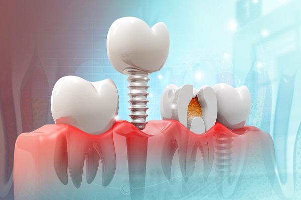 瑞典Nobel種植牙點樣