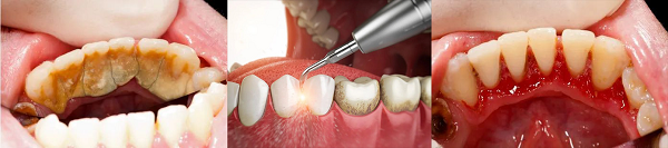洗牙會不會使牙縫變大