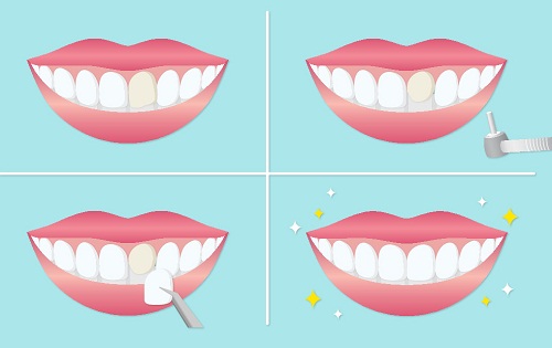 瓷貼面需要磨牙嗎