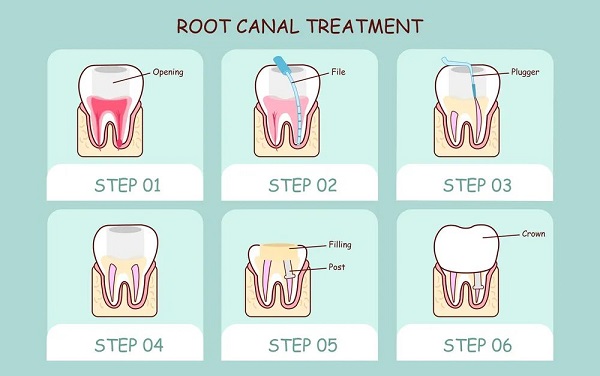 根管治療到底好不好