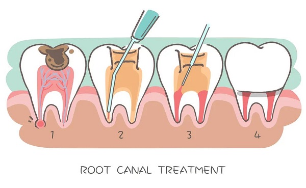深圳杜牙根價錢