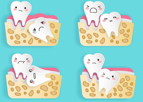 智齒可以一次拔2顆嗎