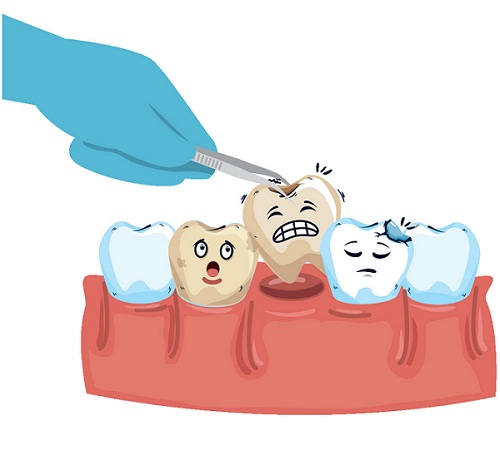 拔牙好還是不好