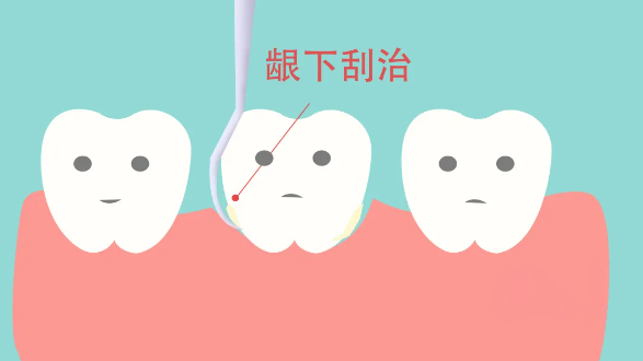 深圳龈下刮治多少錢