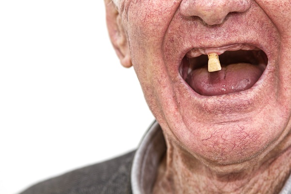 65歲老人適合種植牙齒嗎