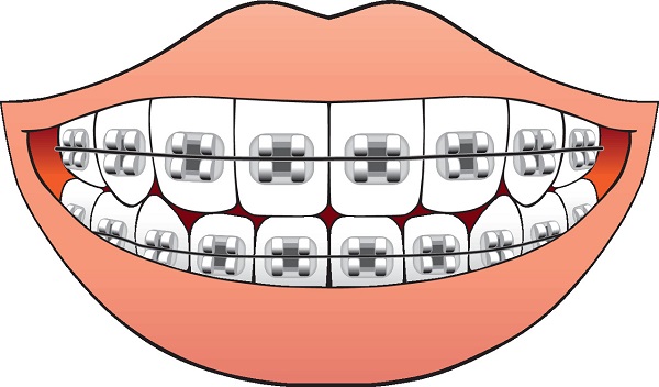 金屬托槽矯正牙齒好不好