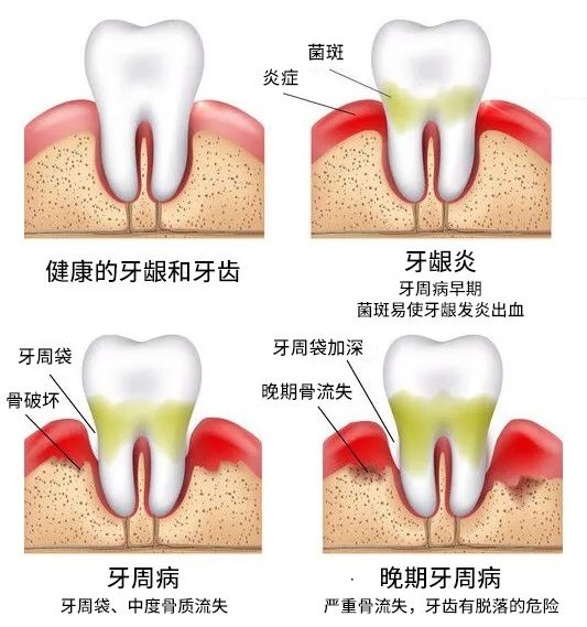 牙結石會導致牙周炎嗎