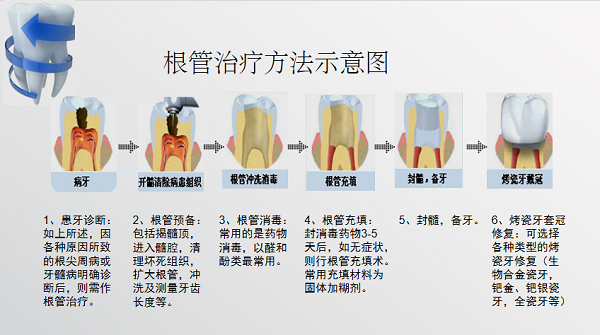 根管治療全過程及步驟